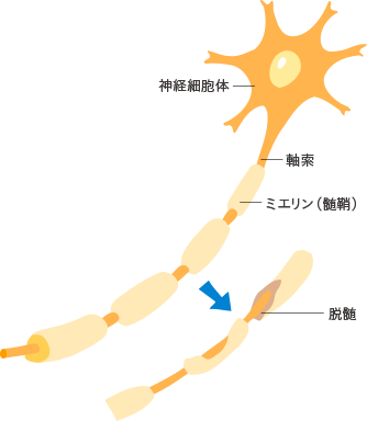 多発性硬化症